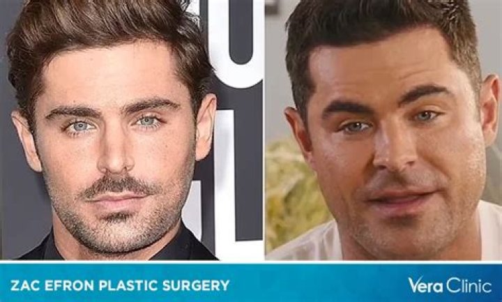 Insights Into Zac Efron's Plastic Surgery Journey
